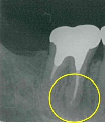 病巣　ct