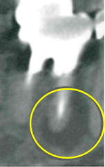病巣　ct