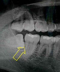 虫歯　ct