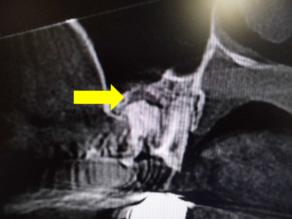 近接する根尖病巣と上顎洞