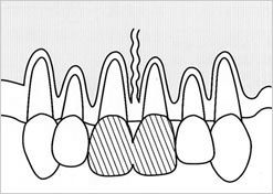 ▼前歯の固定