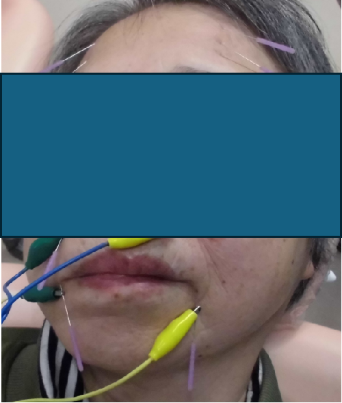 顔面神経麻痺（通電併用）