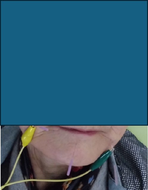 オトガイ神経麻痺（通電併用）