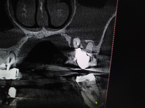 上顎洞への穿孔　粘膜の肥厚