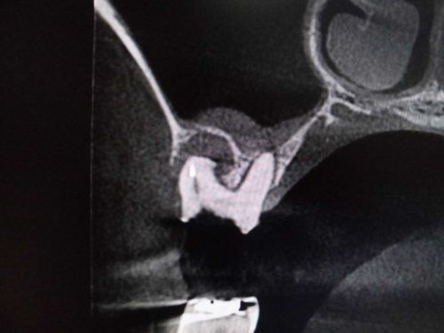 頬側近心根　上顎洞粘膜が肥厚　ct