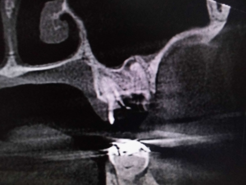 左上７番の根尖が上顎洞へ穿孔していない　ct