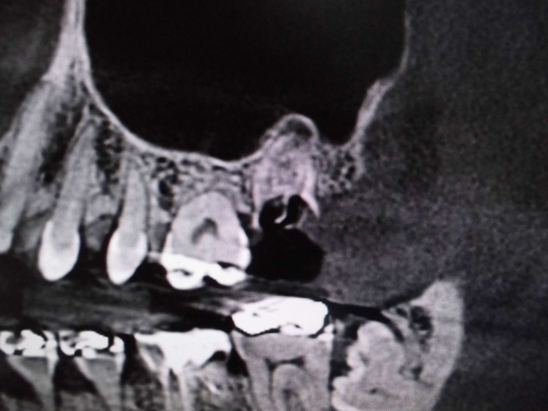 左上７番の根尖が上顎洞へ穿孔していない　ct
